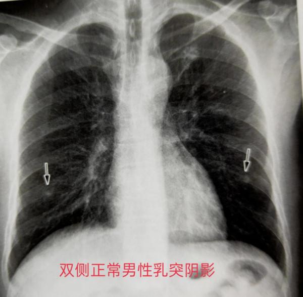 學習《X線讀片指南》之呼吸系統