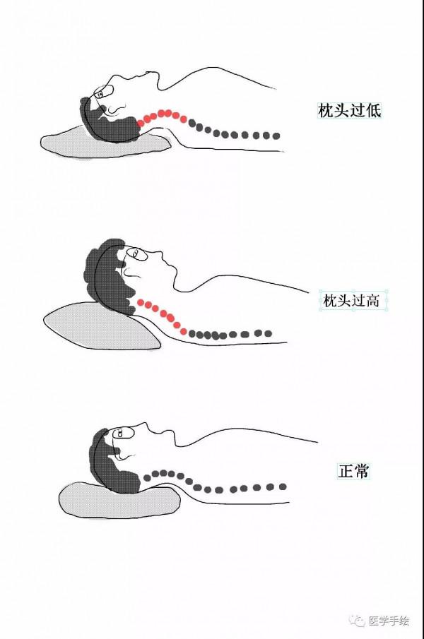 一個枕頭解救頸椎病，還有比它價效比更高的方法嗎？幾張圖說明白