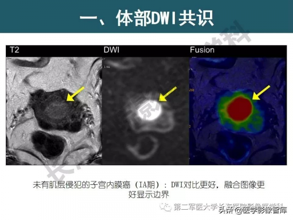 體部DWI共識及胰腺DWI研究經驗介紹