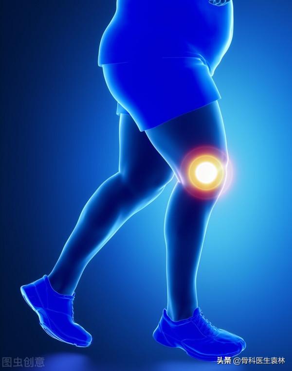 膝蓋骨關節炎的症狀表現有哪些? 膝蓋骨關節炎的症狀表現有哪些?