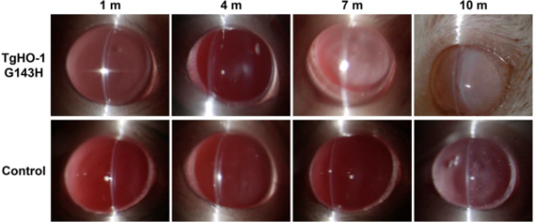 中國之聲丨李朝輝教授:如何系統性做好白內障的基礎研究? 中國之聲丨李朝輝教授:如何系統性做好白內障的基礎研究?