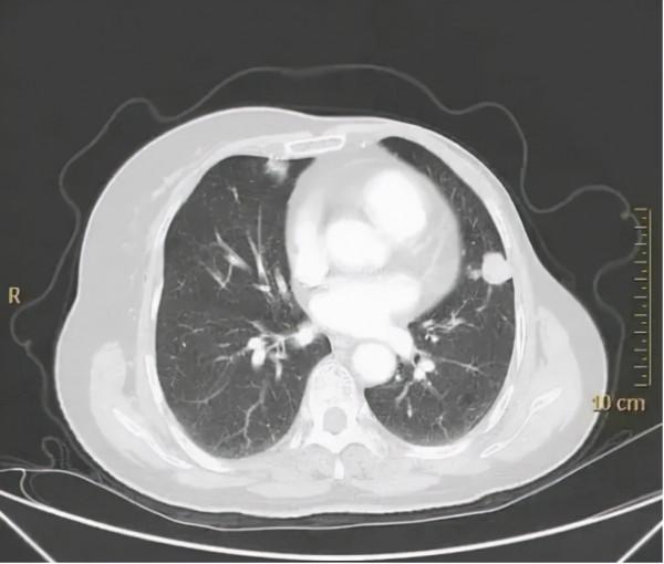 癌症患者極度消瘦？不是癌細胞搶奪營養那麼簡單！如何有效應對？