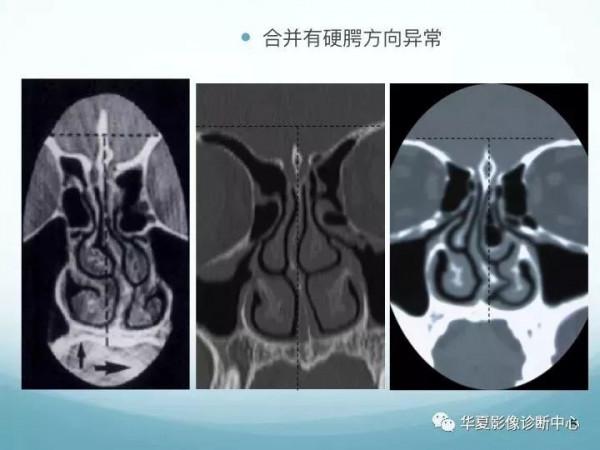 頭頸五官CT斷層解剖圖及常見病影像診斷