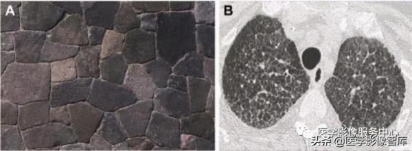 22個肺部疾病的CT徵象 22個肺部疾病的CT徵象