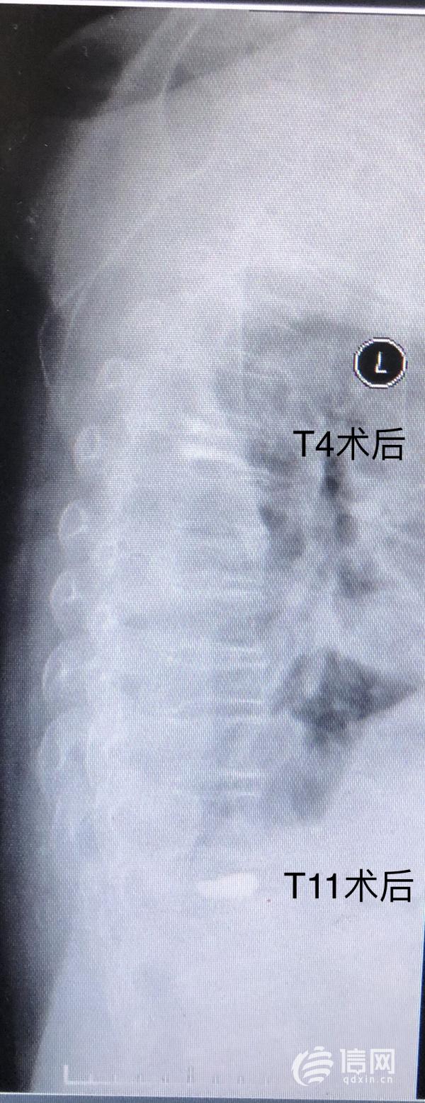 高齡患者遭遇車禍 平度市人民醫院微創手術恢復健康