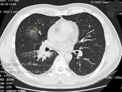 這種肺部多發磨玻璃影會是啥?我突然想到上次分析過的一種罕見病 這種肺部多發磨玻璃影會是啥?我突然想到上次分析過的一種罕見病