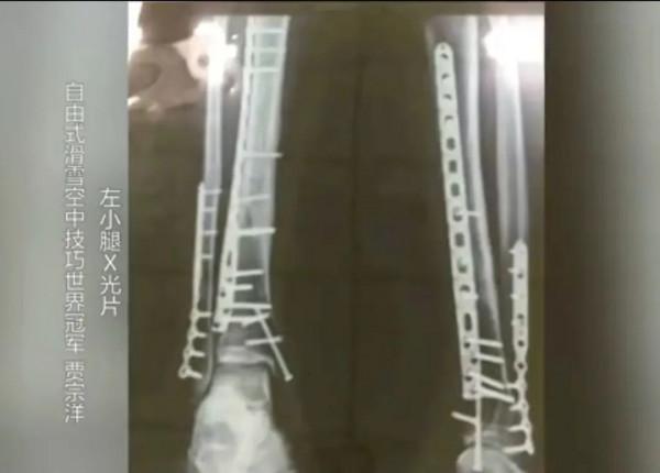 這張X光片刷屏！網友：破大防了......