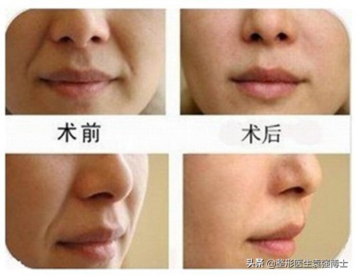 法令紋“分類”解決才有用,聽醫生給你支幾招 法令紋“分類”解決才有用,聽醫生給你支幾招