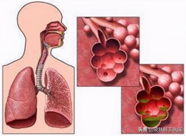 “布病”到底是什麼病?如何傳染的?能治好麼? “布病”到底是什麼病?如何傳染的?能治好麼?