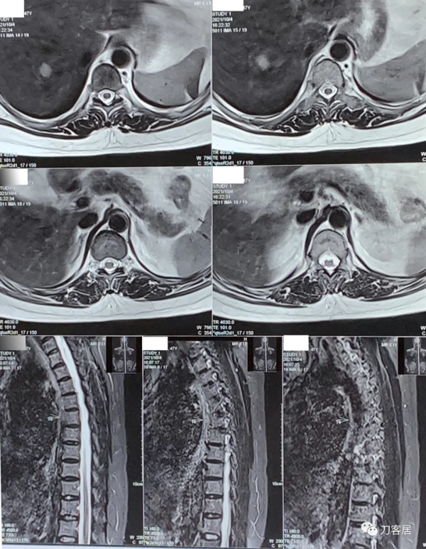 查體的重要性，一直按照腰椎間盤突出症治療的脊髓型頸椎病