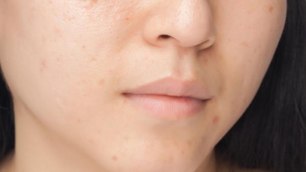 對於改善敏感肌，“少”是關鍵，以少為多才能讓肌膚屏障好得快