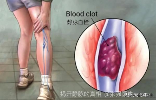 患了急性深靜脈血栓，多久可以下地行走？