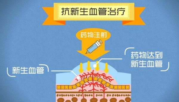 醫生告訴你癌細胞是如何被“餓死的”，抗血管生成藥物大盤點