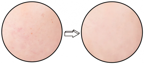 臉上長斑，除了醫美還能怎麼辦？