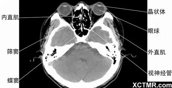 頭頸五官CT斷層解剖圖及常見病影像診斷