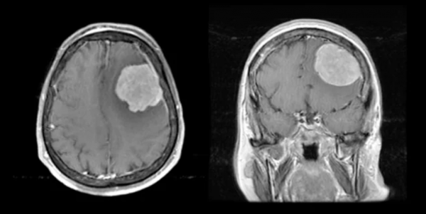 9種腦部病變,一文識別丨臨床必備 9種腦部病變,一文識別丨臨床必備