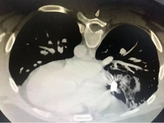 突發心梗，速效救心丸和硝酸甘油，哪個才能緊急救命？