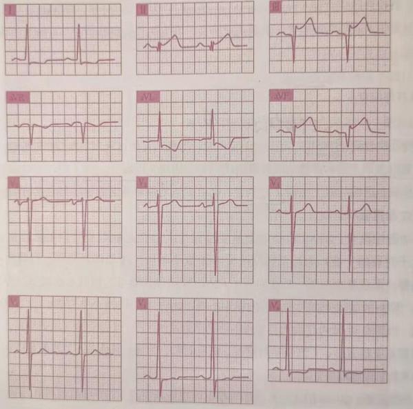 急性心肌梗死（一）