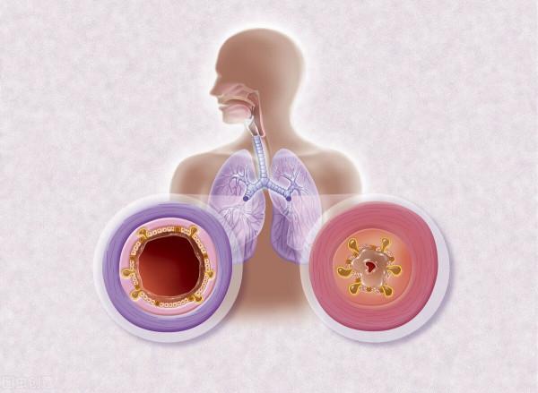 支氣管炎咳嗽有白痰用什麼藥 支氣管炎咳嗽有白痰用什麼藥