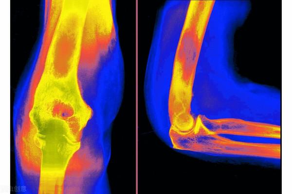腰痠、腰痛一定是腎臟有問題嗎 腰痠、腰痛一定是腎臟有問題嗎