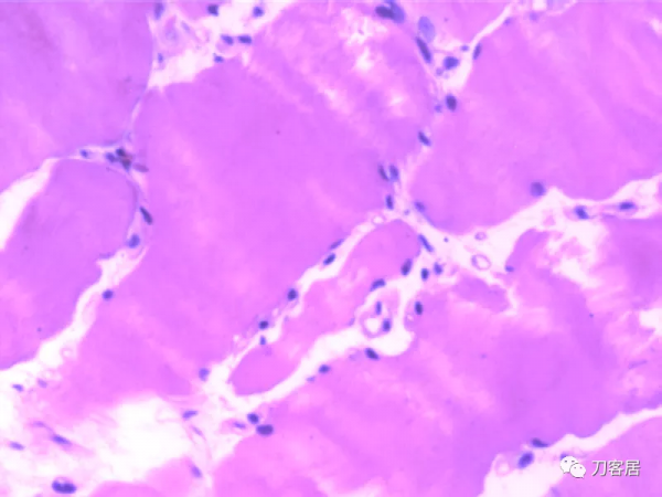 惡性高熱第3例：12歲，脊柱側彎，矯形術後死亡