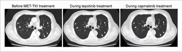 卡馬替尼成功克服了Tepotinib引起的無法耐受的外周水腫 卡馬替尼成功克服了Tepotinib引起的無法耐受的外周水腫