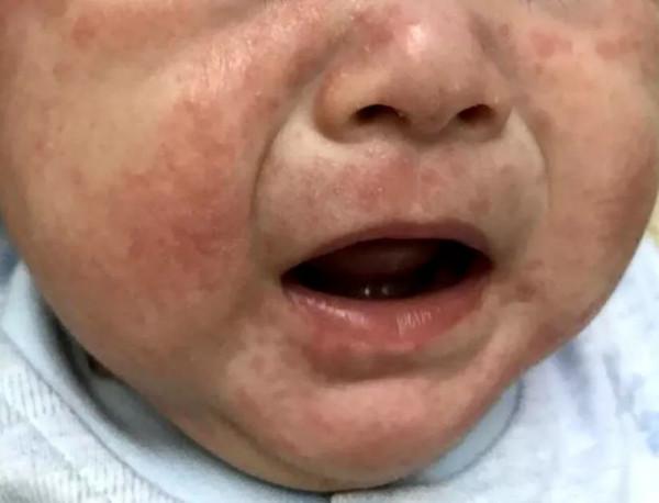 嬰兒溼疹與保溼 嬰兒溼疹與保溼