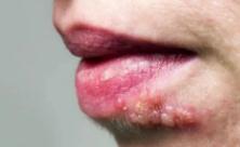 嘴角起泡，不都是上火那麼簡單！小小皰疹，竟奪走了多名孩子的生命？