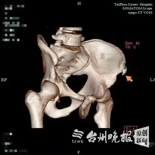 接力跑後,3名學生同時骨折,竟然傷了同一部位!醫生提醒:家長要注意啦 接力跑後,3名學生同時骨折,竟然傷了同一部位!醫生提醒:家長要注意啦