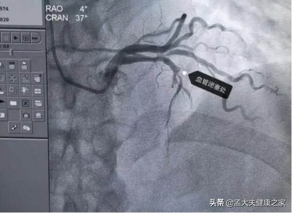 血管“堵”了,心梗、腦中風、猝死來敲門?用5招拯救血管 血管“堵”了,心梗、腦中風、猝死來敲門?用5招拯救血管