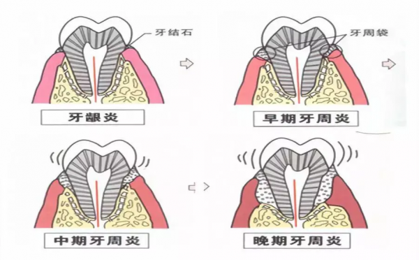 老年人牙疼是怎麼回事? 老年人牙疼是怎麼回事?