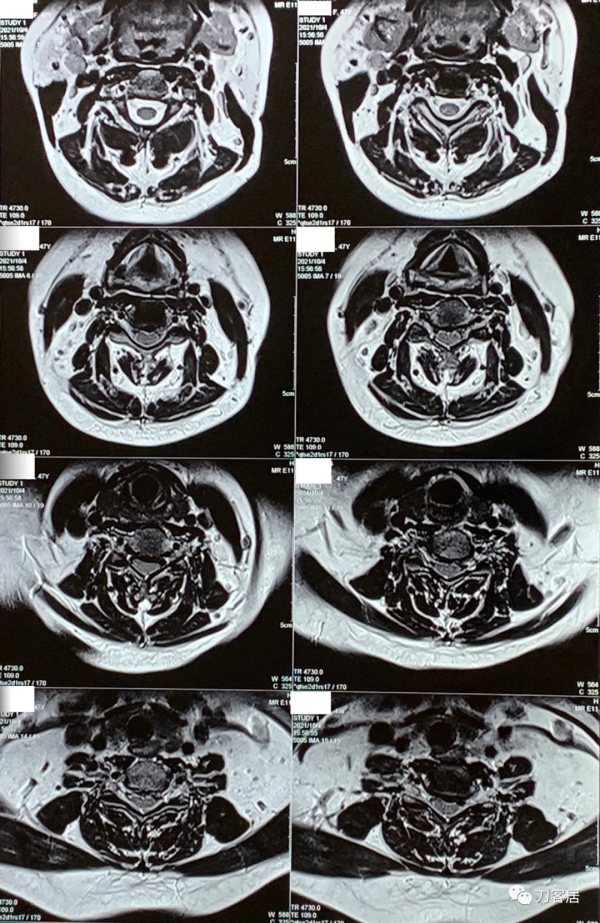查體的重要性，一直按照腰椎間盤突出症治療的脊髓型頸椎病