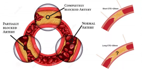 再克技術堡壘，巧破閉塞病變