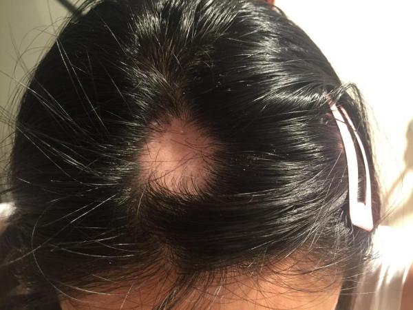 鬼剃頭是怎麼回事？斑禿成因中西醫看法大不同，多久能恢復？