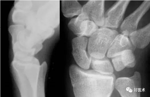 贊！腕關節X線高畫質解剖+腕骨脫位典型病例