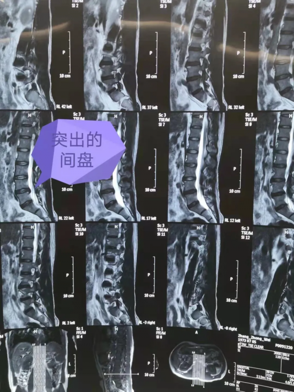 妙手除病痛，德高暖人心——骨科成功救治腰椎間盤突出重疾患者