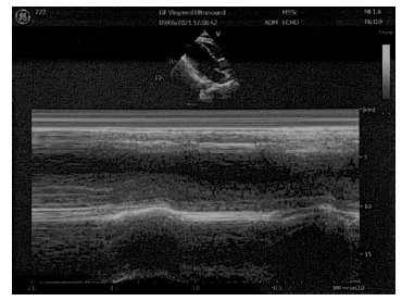 女性，26歲，教師，間斷心悸2個月，她怎麼了？