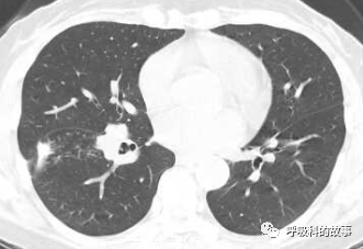 咳嗽半年反覆肺炎為什麼治不好 細看影像發現端倪緣是異物堵塞
