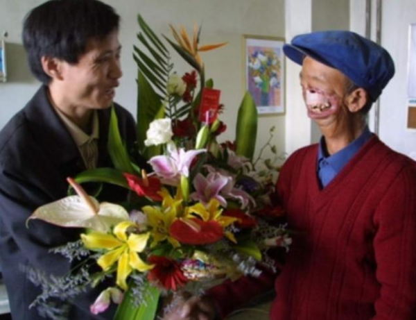 寇金成:三歲時被狼咬掉半張臉,靠吸米糊存活,娶妻後如何生活? 寇金成:三歲時被狼咬掉半張臉,靠吸米糊存活,娶妻後如何生活?