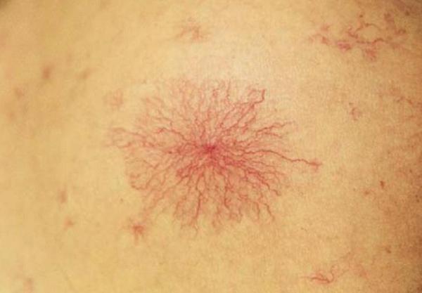 轉氨酶超出正常範圍，就是肝損傷嗎？