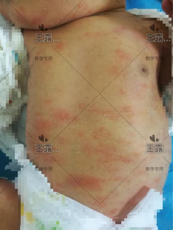 新生兒一過性面板病（上）