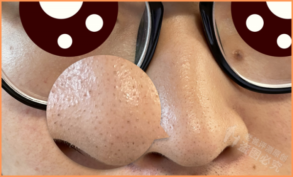 毛孔粗大怎麼辦?超全指南解決你的毛孔問題 毛孔粗大怎麼辦?超全指南解決你的毛孔問題