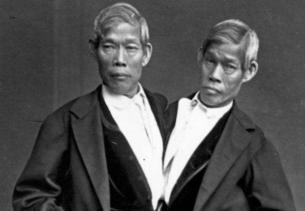 兩個大腦指揮一個身軀,真的能保證不吵架嗎?連體嬰生活大揭秘 兩個大腦指揮一個身軀,真的能保證不吵架嗎?連體嬰生活大揭秘