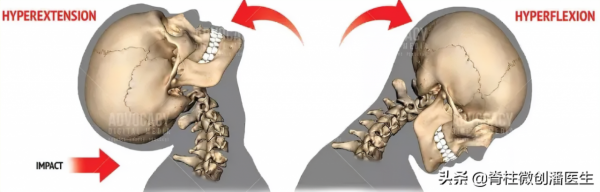 如何實現頸椎術後快速康復