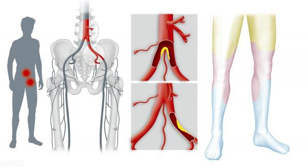 體內有病，腿部先知？醫生提醒：腿上出現3種異常，警惕疾病來襲