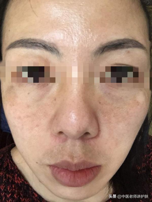 色斑也得分類別，從中醫角度淺談色斑成因，這樣治療更有效