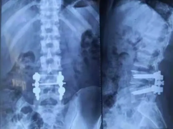 妙手除病痛，德高暖人心——骨科成功救治腰椎間盤突出重疾患者