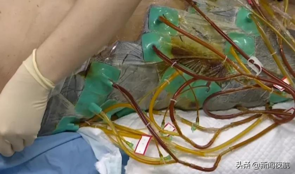 只用三四天，面板從腋下爛到大腿，這是啥病啊？