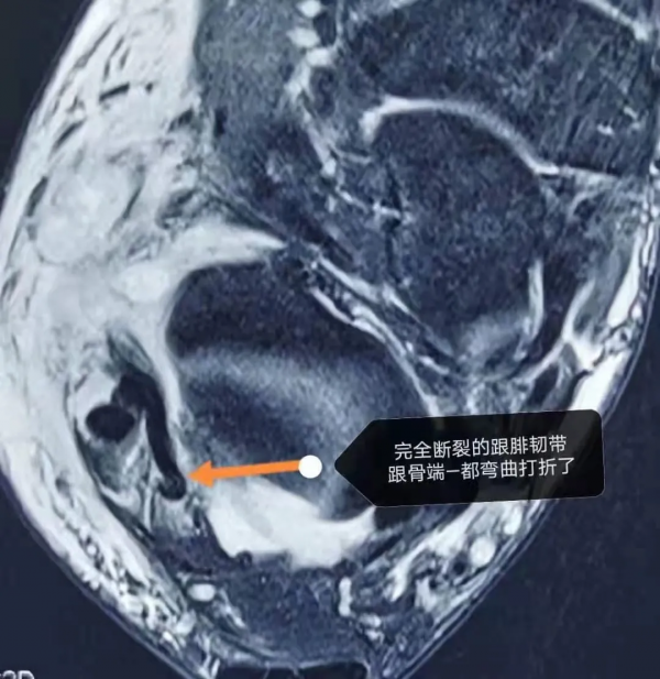 踝關節扭傷,骨頭沒事就真的沒事嗎? 踝關節扭傷,骨頭沒事就真的沒事嗎?