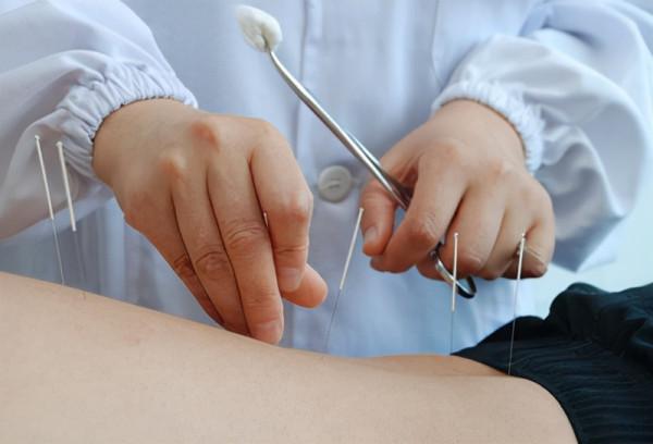 中醫針灸不傳之秘燒山火、透天涼究竟該如何操作? 中醫針灸不傳之秘燒山火、透天涼究竟該如何操作?